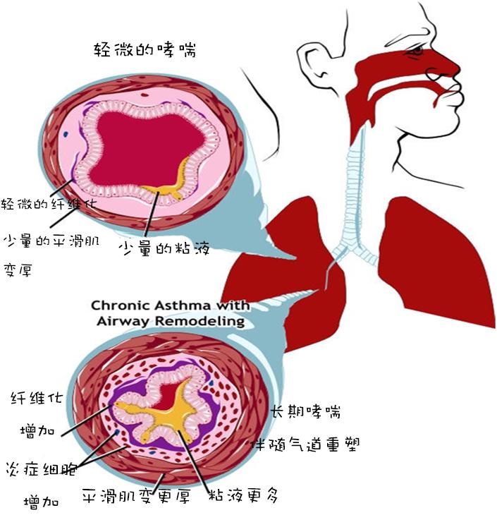 哮喘犯了视频_哮喘犯病视频_视频哮喘犯病是真的吗