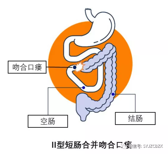 罗克恩病早期症状_罗克罗恩病_克罗恩病治疗多少钱