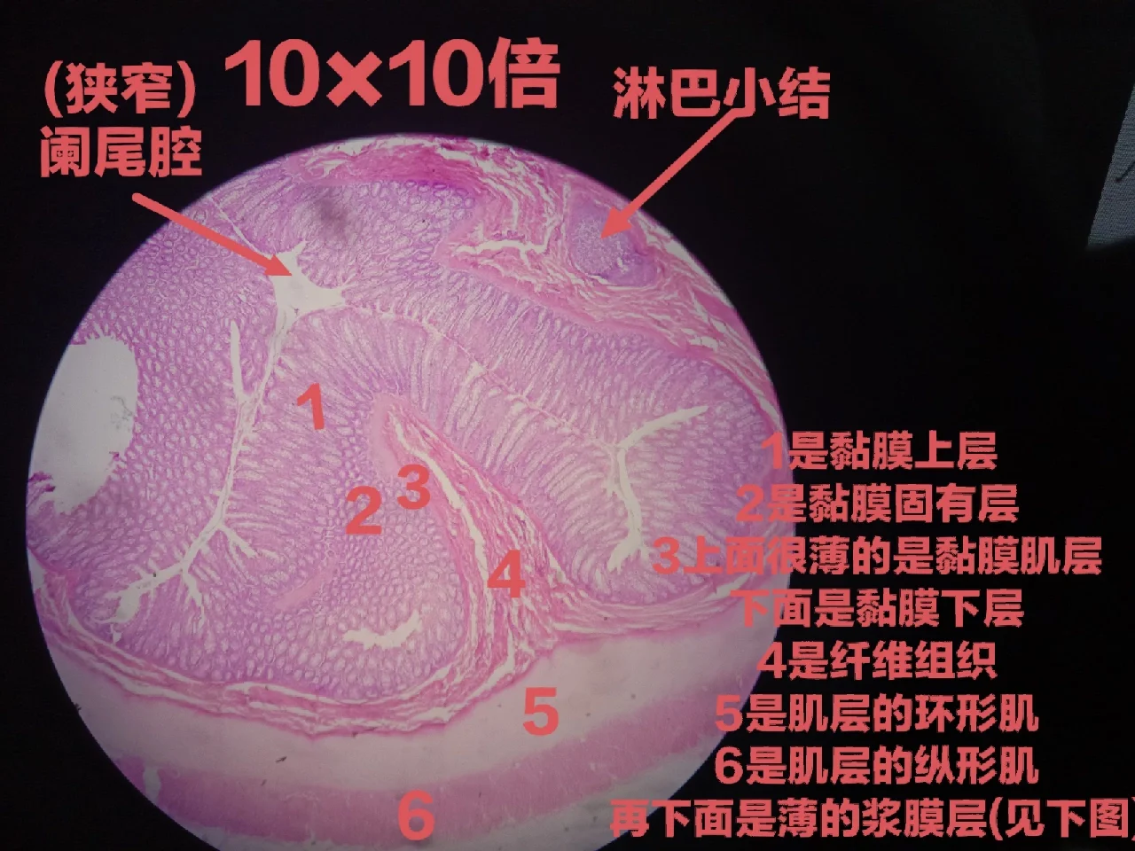 急性化脓性阑尾炎术后护理_急性化脓性阑尾炎术后护理_急性化脓性阑尾炎术后护理