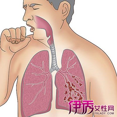 肺结核严重不_肺结核严重了会引起什么后果_肺结核严重吗?