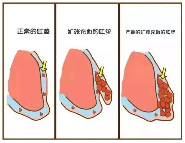 肛门手术失禁怎么回事_肛门手术后失禁_肛门失禁手术