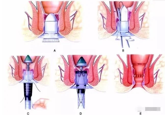 肛门手术失禁怎么回事_肛门手术后失禁_肛门失禁手术