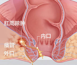 肛门手术失禁怎么回事_肛门手术后失禁_肛门失禁手术