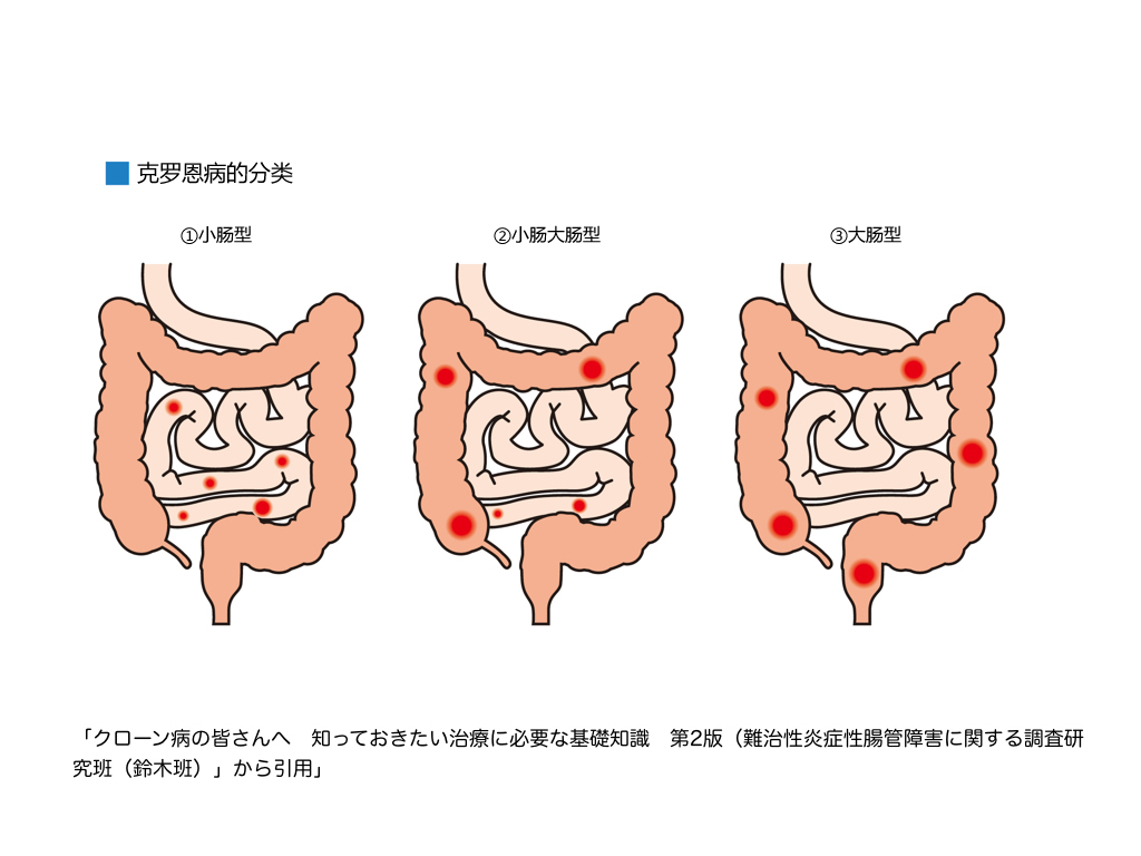 克罗恩病能治好吗-克罗恩病：难缠的慢性炎症性肠病，虽无法根治但可控制病情