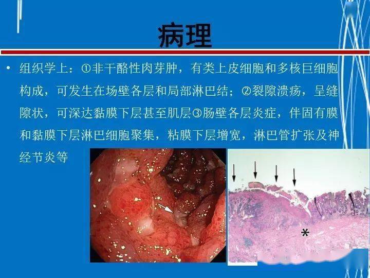 克罗恩cdai评分怎么算_克罗恩病cdai评分表简化_克罗恩病cdai评分