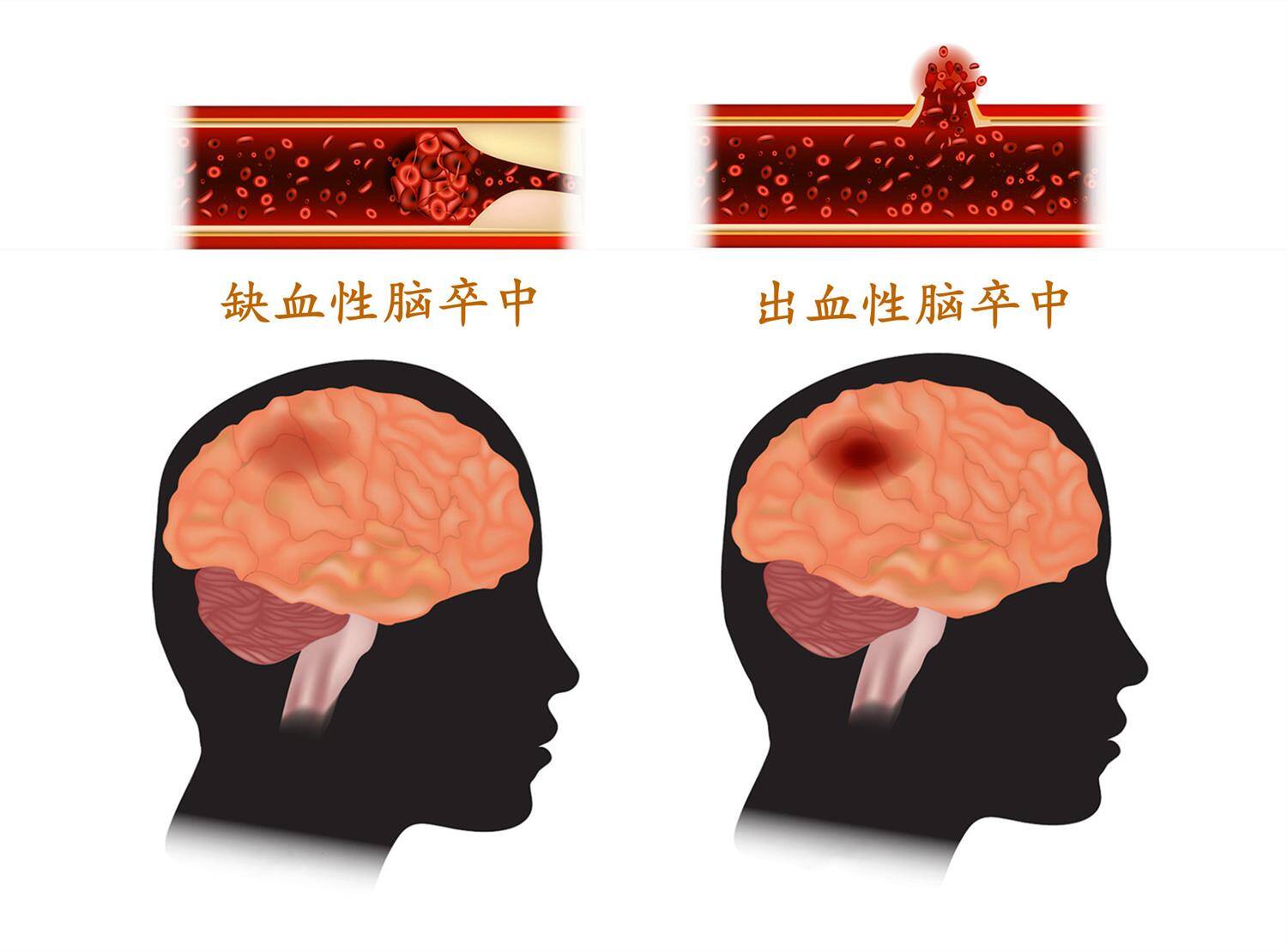 急性进展性脑卒中突然来袭，如何应对这无情的病魔？