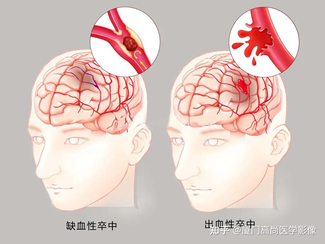 急性进展脑性卒中发病机制_急性脑卒中包括哪些_急性进展性脑卒中